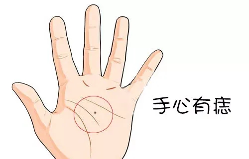 手掌有痣图解大全 手掌有痣代表什么意思